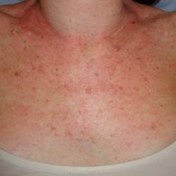 Example of pigmentation